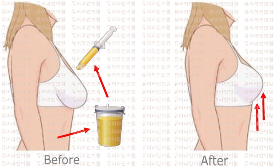 Breast Fat graft Image