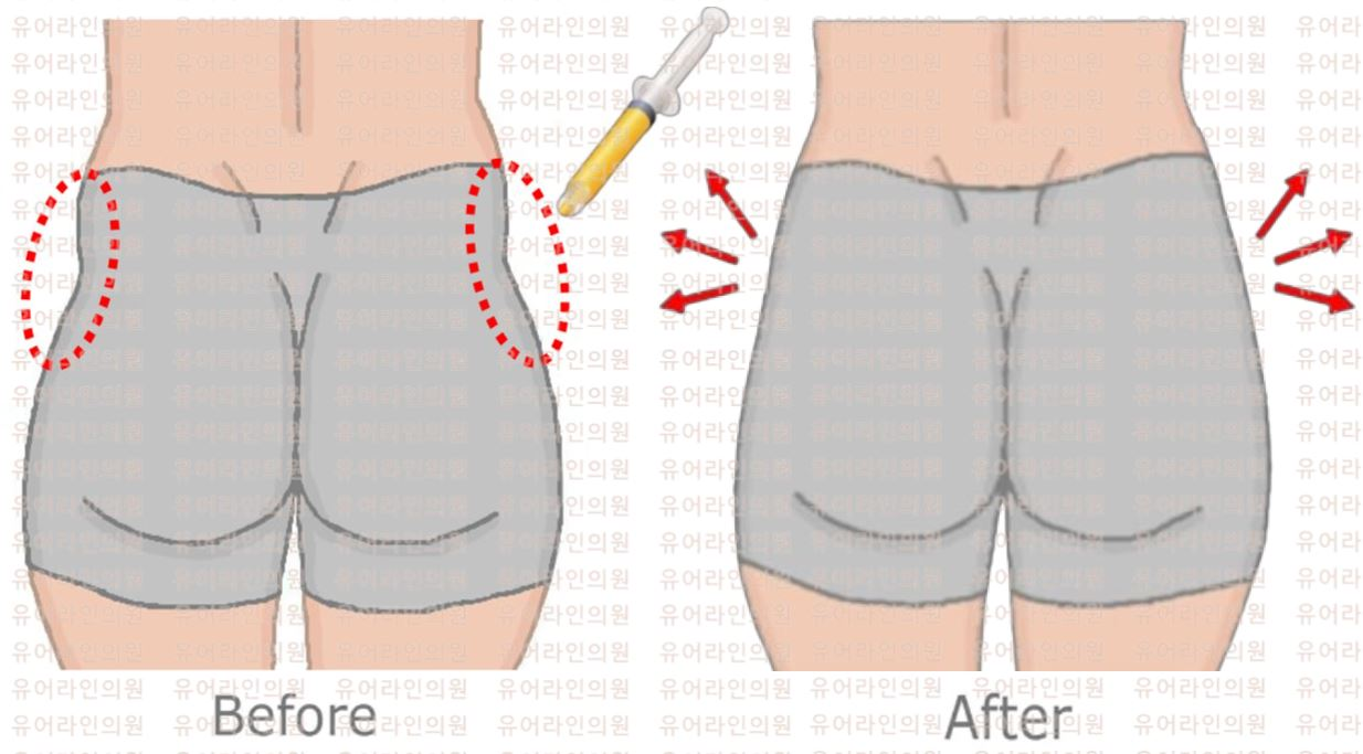 Hip-dip Fat graft Image