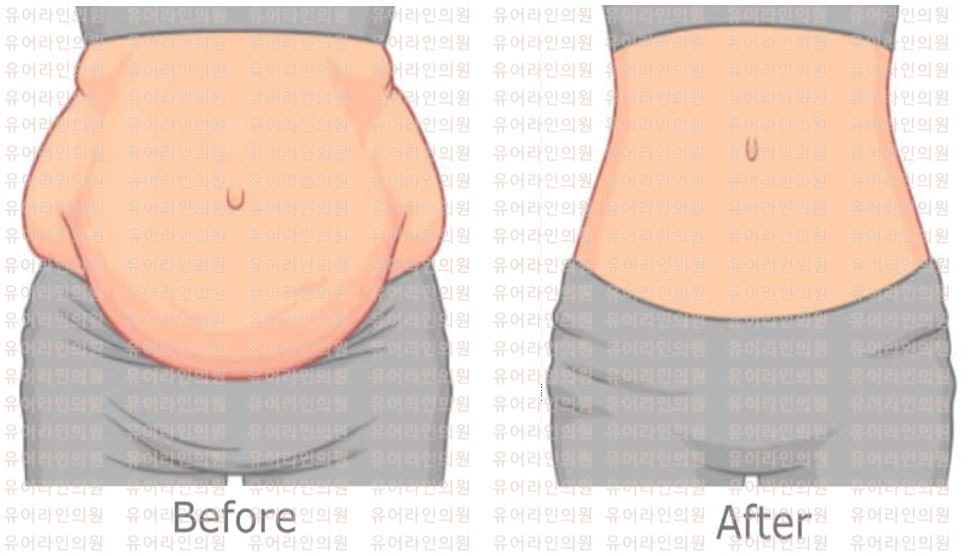 Abdomen Liposuction Image