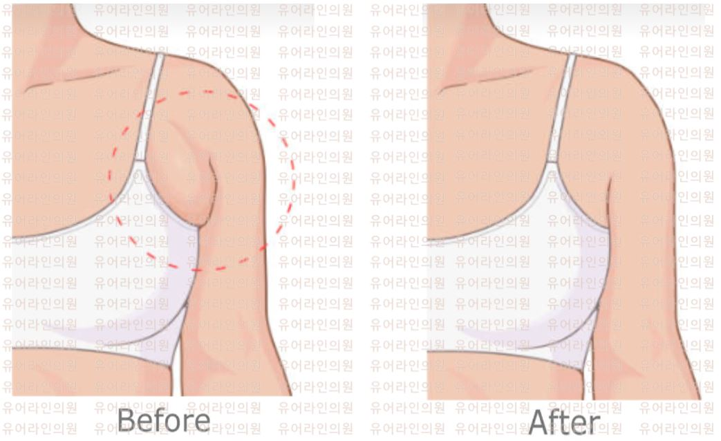 Accessorybreast Liposuction Image