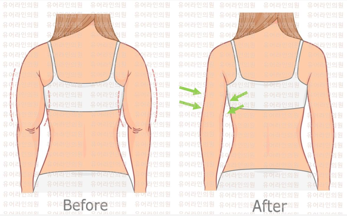 Arm Liposuction Image 2