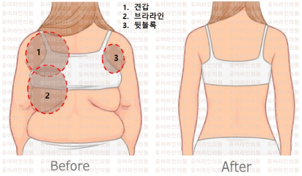 Back Liposuction Image