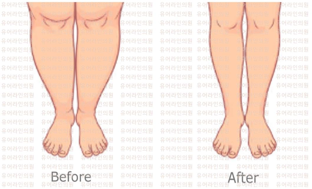 Calf Liposuction Image