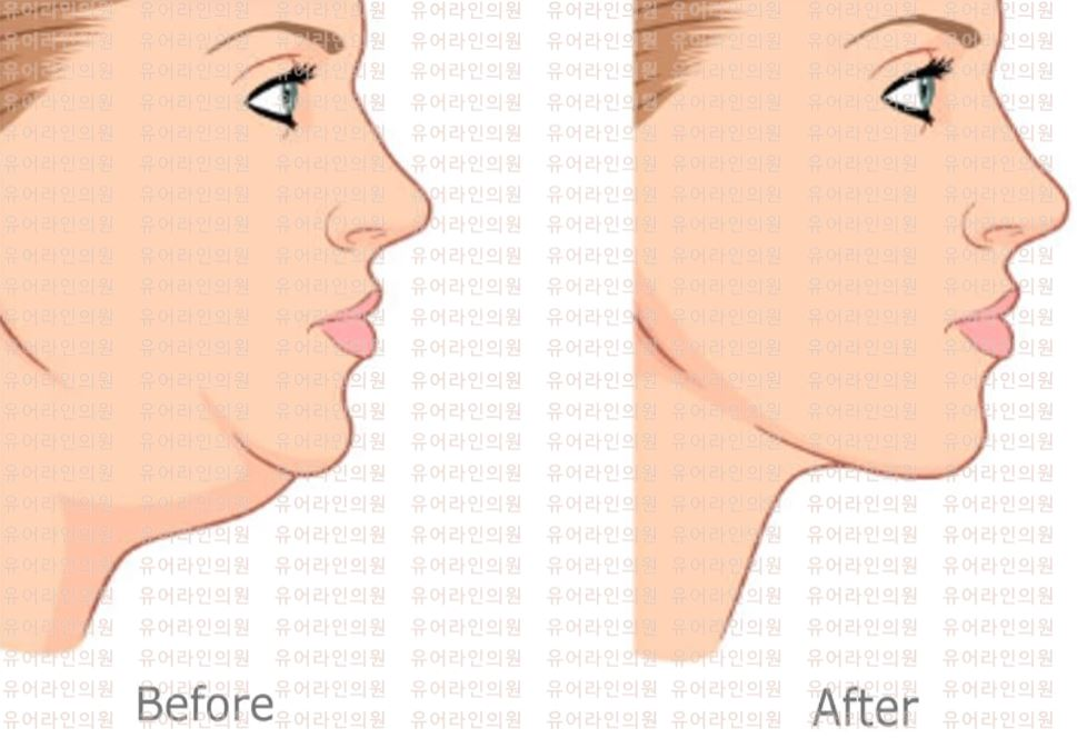 Doublechin Liposuction Image