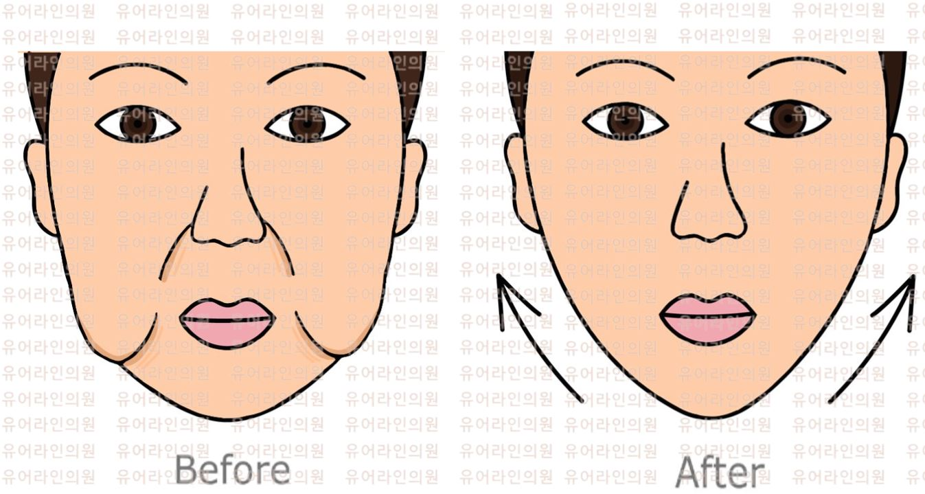 Face Liposuction Image