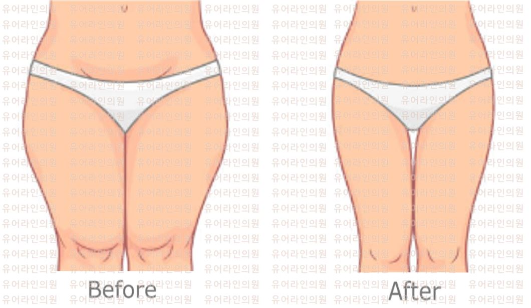 Thigh Liposuction Image