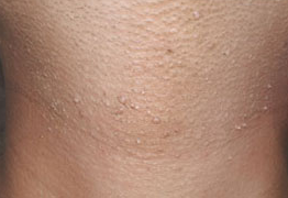 neck verrucaplana Image